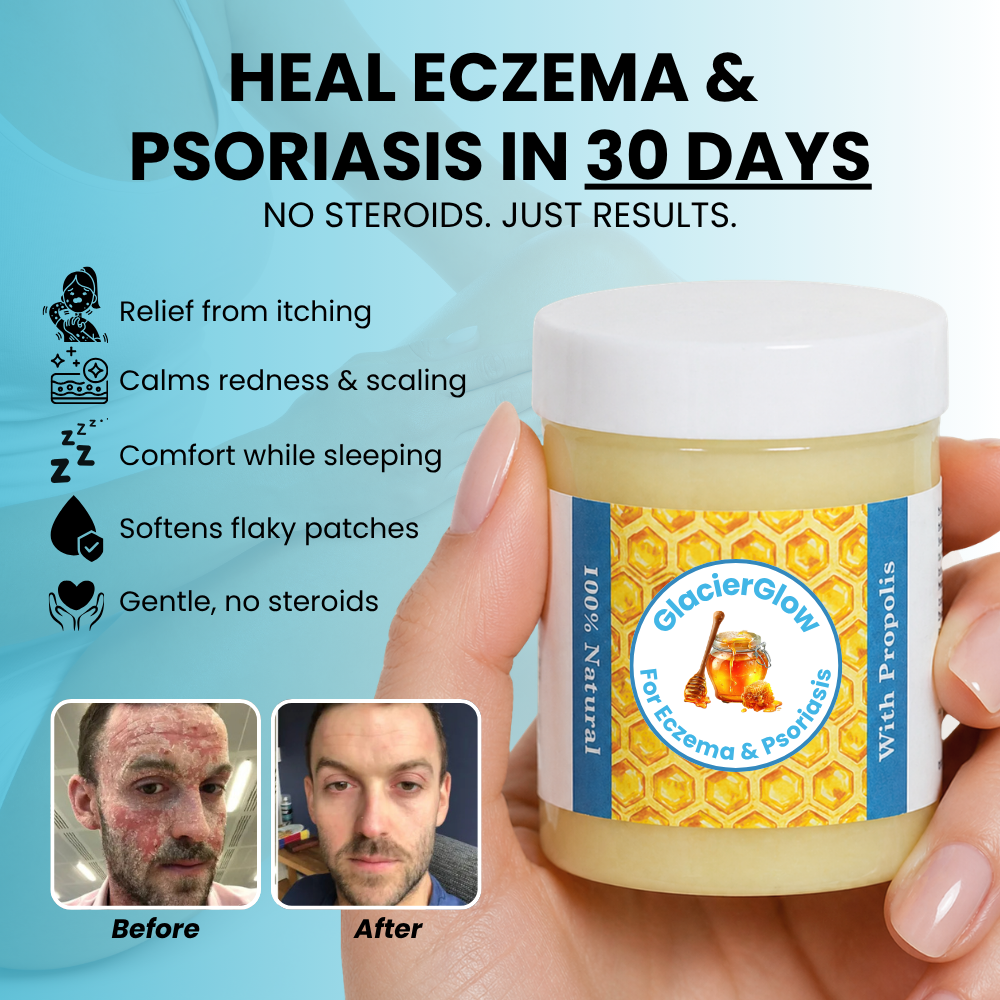 GlacierSkin - Repair Balm For Eczema & Psoriasis