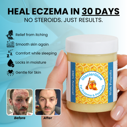 GlacierSkin - Repair Balm For Eczema & Psoriasis
